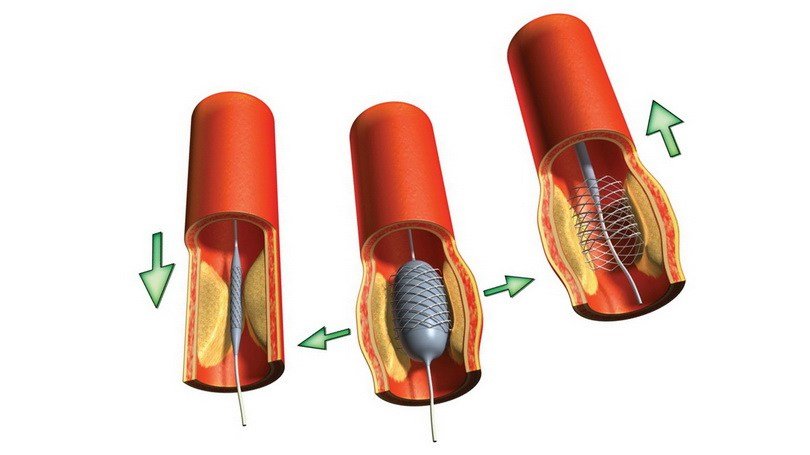 angioplastika-pri-ateroskleroze