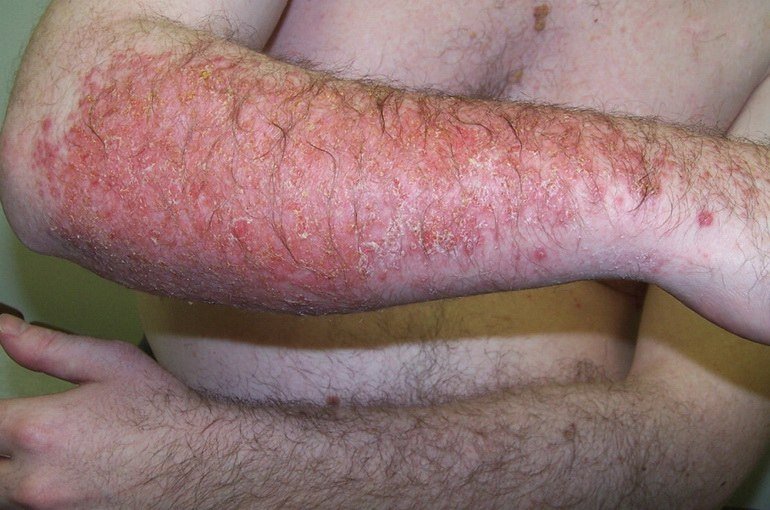 Аллергический контактный дерматит на руке