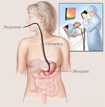 Диагностика эзофагита