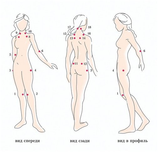Болевые точки при фибромиалгии