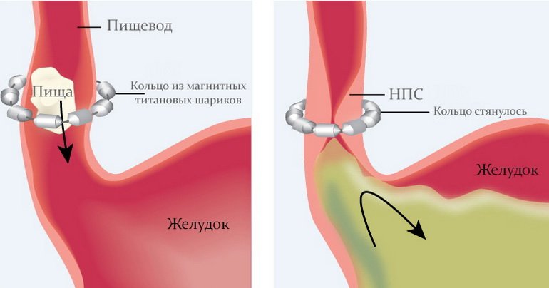 Фундопликация по Ниссену