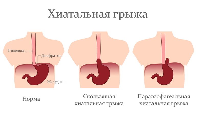 Хиатальная грыжа