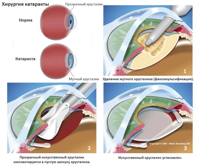Хирургия катаракты