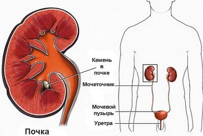 Камни в почках и ИМП