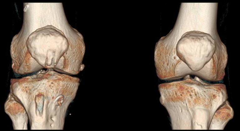 КТ как инструмент своевременной и полной диагностики проблемы с коленями