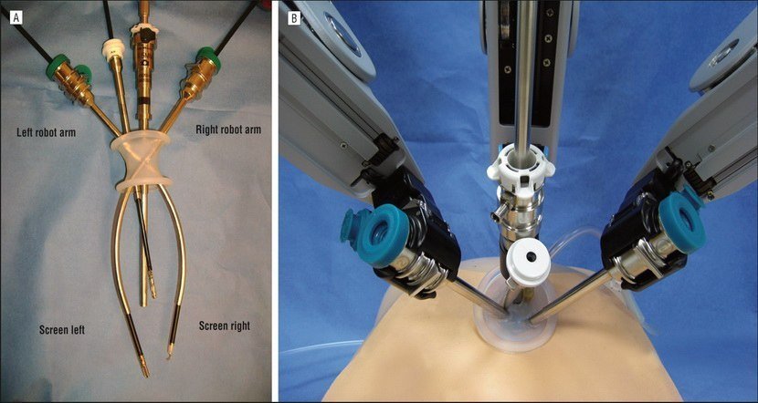 Лапароскопическая холецистэктомия - оборудование для проведения операции