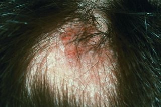 Один из симптомов псориаза волосистой части головы
