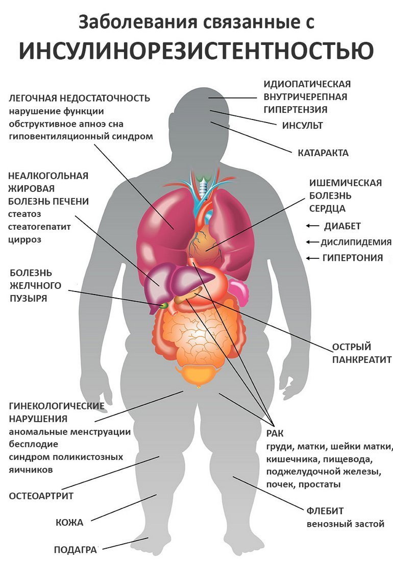 Заболевания связанные с инсулинорезистентностью