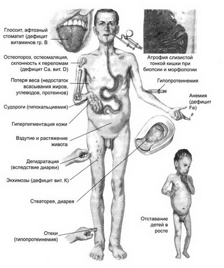 Симптомы и признаки мальабсорбции у взрослых и детей