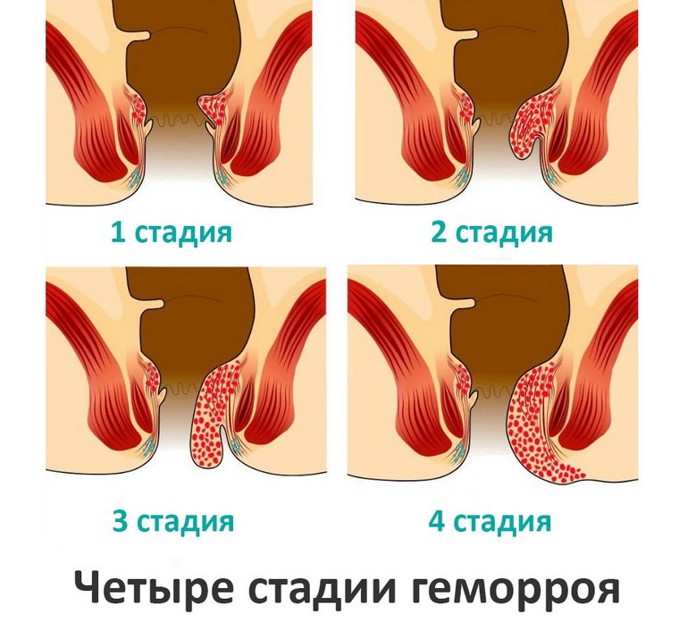 4 стадии геморроя