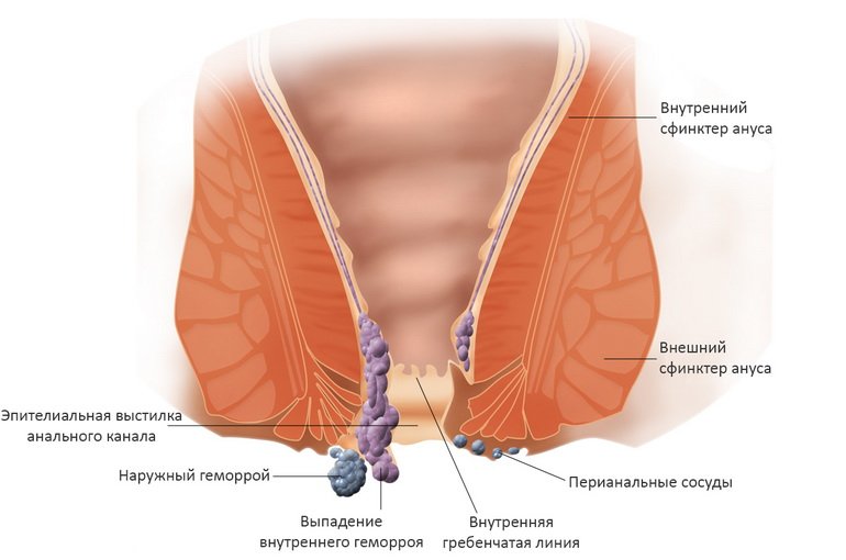 Геморрой