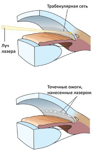 Трабекулопластика