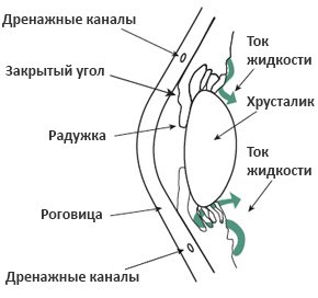 Закрытоугольная глаукома