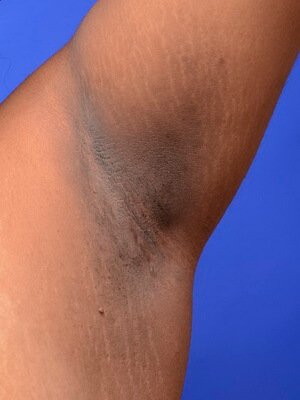 Черный акантоз (Acanthosis nigricans)