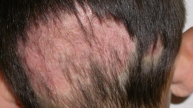 Стригущий лишай волосистой части головы на затылке (опоясывающий лишай волосистой части головы)