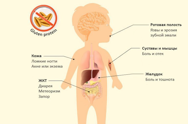 Симптомы целиакии у детей