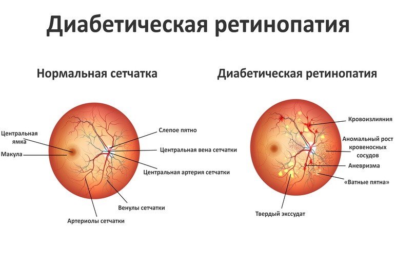 Диабетическая ретинопатия: симптомы, лечение, профилактика