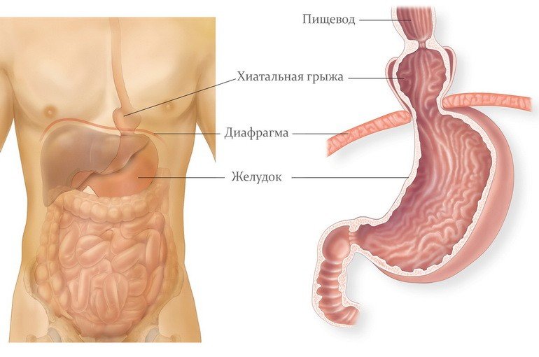 Грыжа пищеводного отверстия диафрагмы: симптомы, причины, лечение