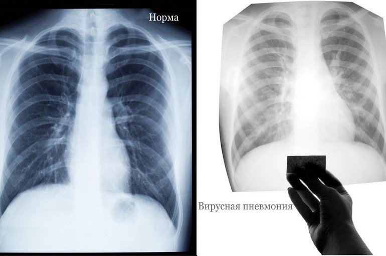 Острый бронхит и пневмония - отличия