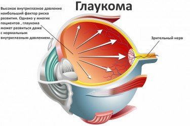 Глаукома: что это такое, как лечить, операция, причины, симптомы