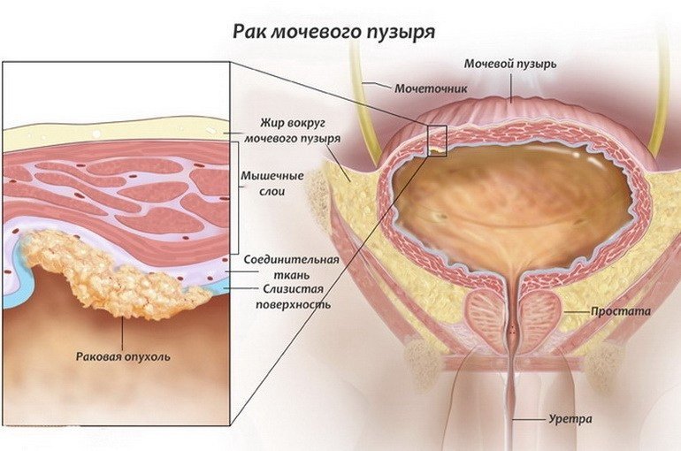 Почему болит мочевой пузырь? Что делать?