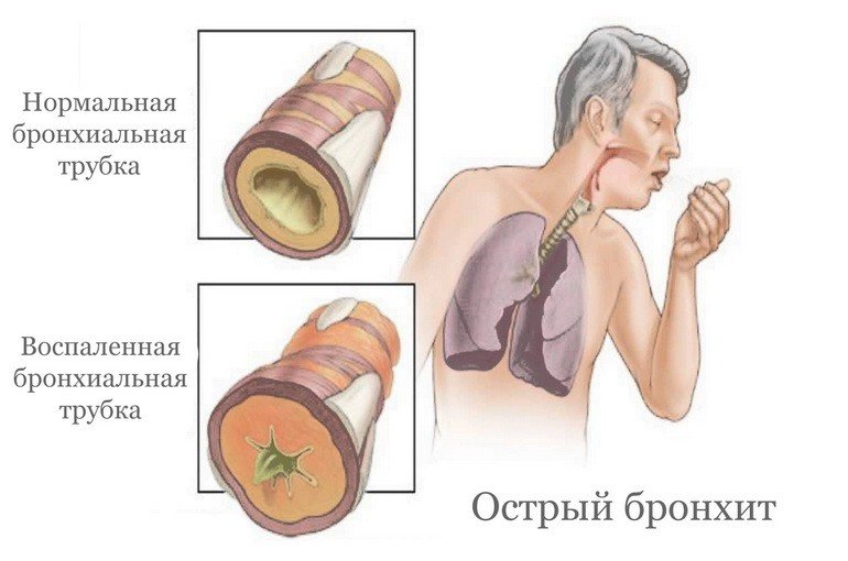 Острый бронхит: симптомы и лечение у взрослых, причины, профилактика