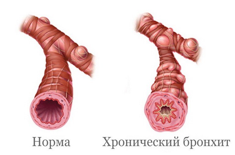 Хронический бронхит: симптомы и лечение у взрослых, причины, профилактика