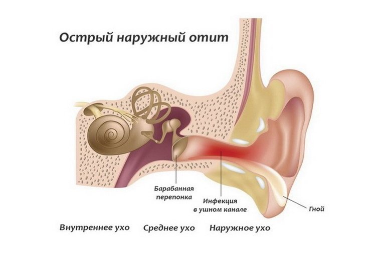 Острый наружный отит: причины, симптомы, лечение