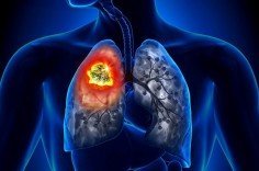 Рак легких: причины, симптомы, разновидности заболевания и прогнозы