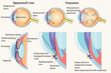 Открытоугольная глаукома: причины, симптомы, лечение и профилактика