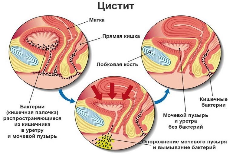 Цистит: причины, симптомы, лечение, факторы риска