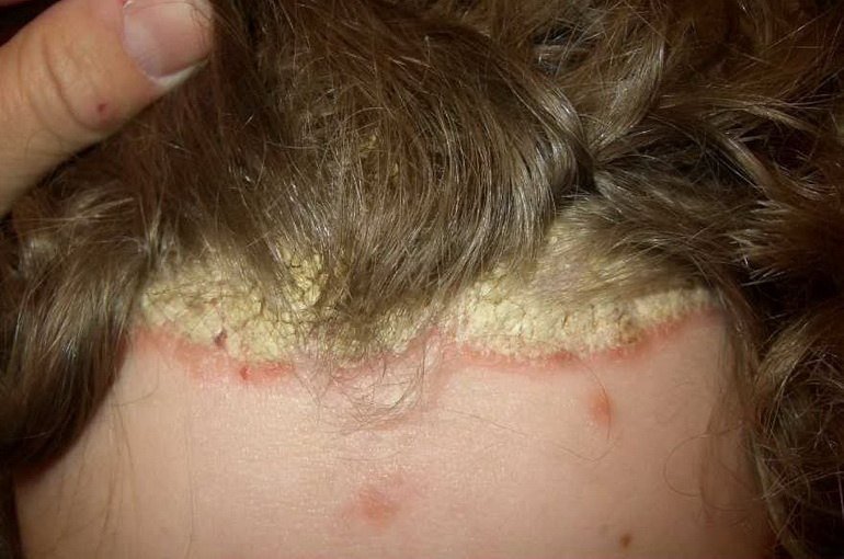Псориаз волосистой части головы: симптомы, причины, лечение
