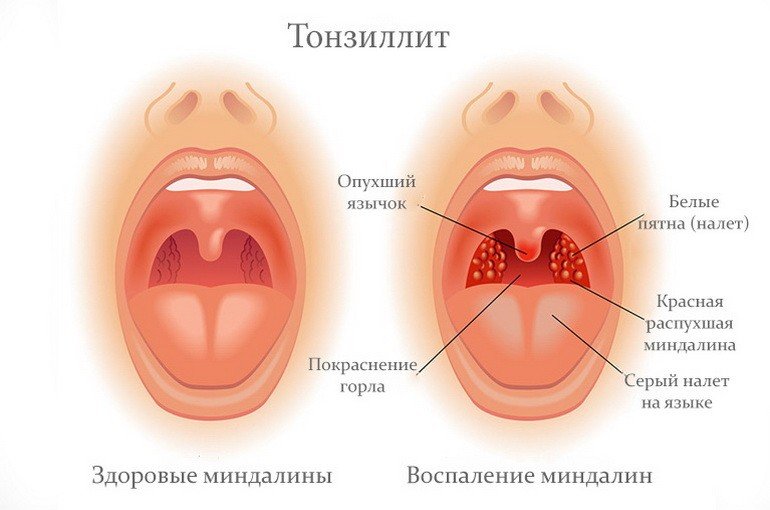 Как лечить тонзиллит: основные способы лечения