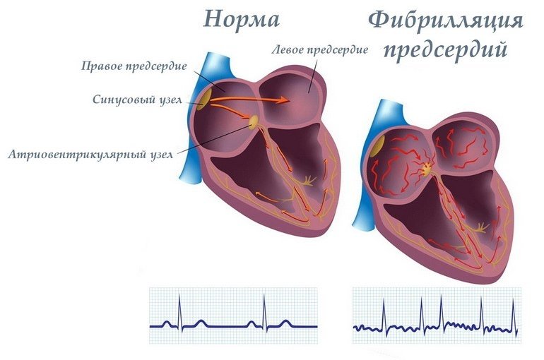 Фибрилляция предсердий: причины, симптомы, лечение