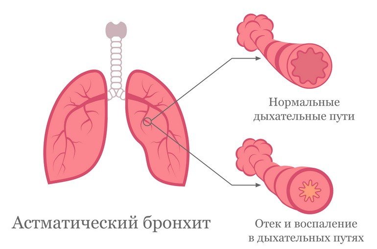 Хронический астматический бронхит: симптомы и лечение