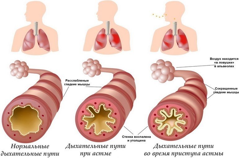 Астма: причины, симптомы, лечение народными средствами