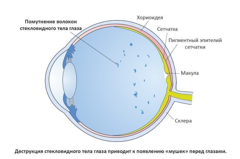 Мелькание «мушек» перед глазами: причины и лечение