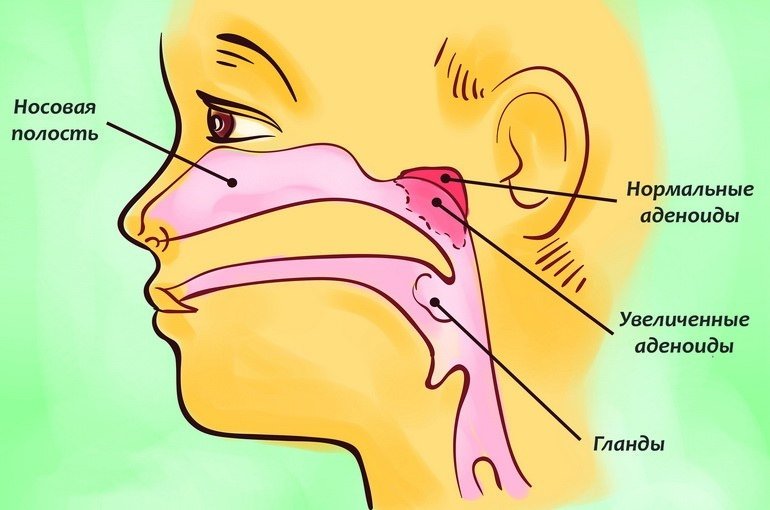 Увеличенные аденоиды у ребенка: причины, симптомы, лечение