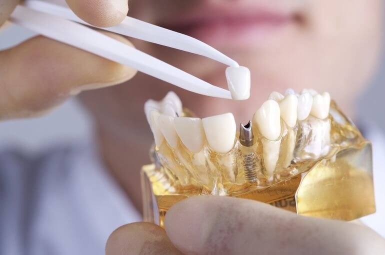 Протезирование зубов: виды протезов и способы их установки