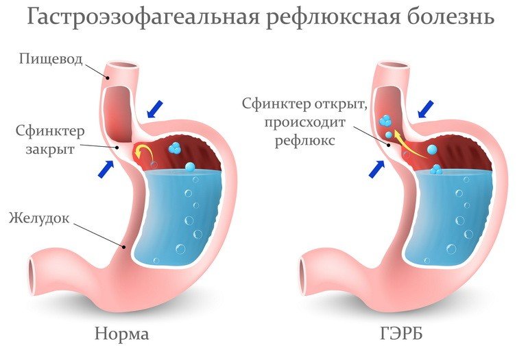 Гастроэзофагеальная рефлюксная болезнь (ГЭРБ): причины, симптомы, лечение