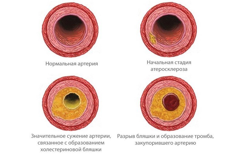 Холестериновые бляшки: факторы риска, лечение, профилактика