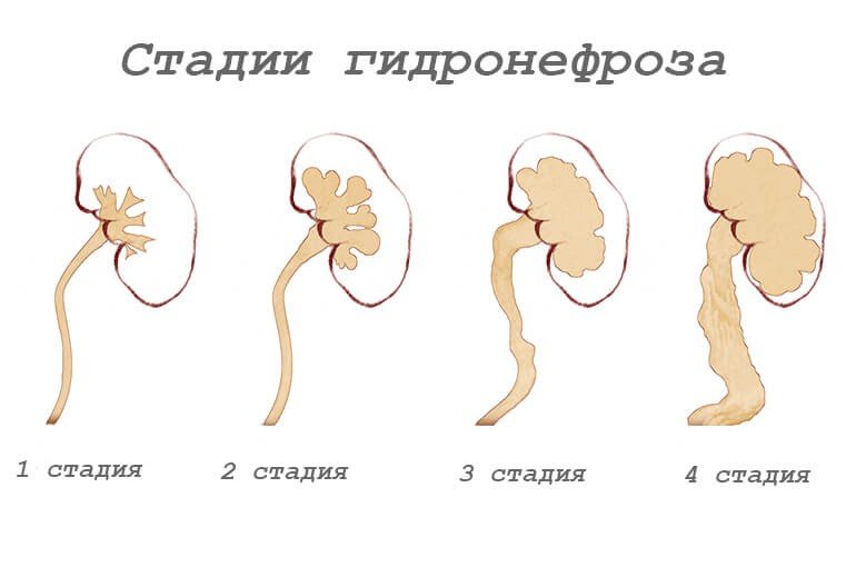 4 Стадии гидронефроза