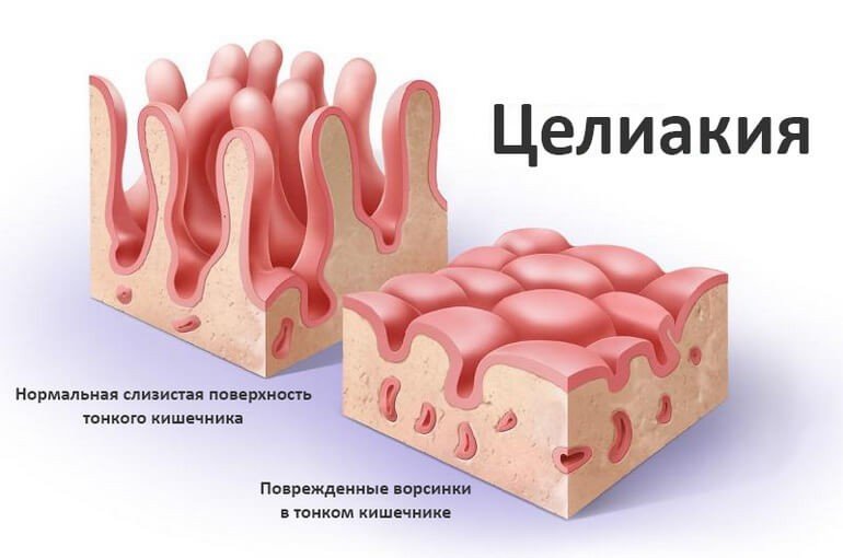 Целиакия: причины, симптомы, лечение, диагностика