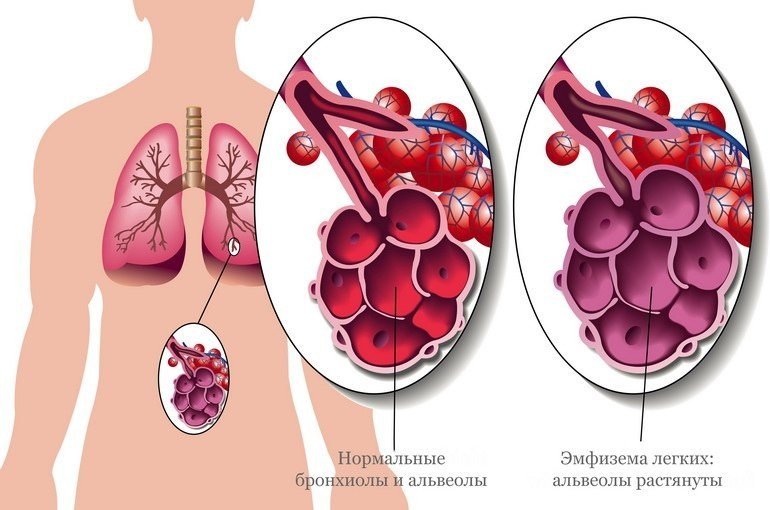 Эмфизема легких: что это такое, как лечить в домашних условиях