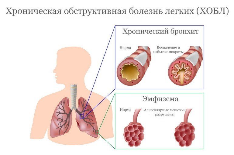 Хроническая обструктивная болезнь легких: симптомы, причины, лечение