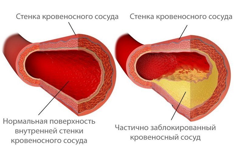 Стадии атеросклероза