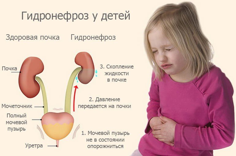 Гидронефроз у новорожденных и детей постарше