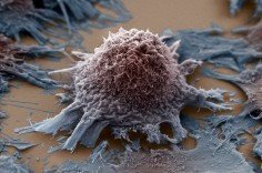 Как рак вызывает угрожающие жизни осложнения?
