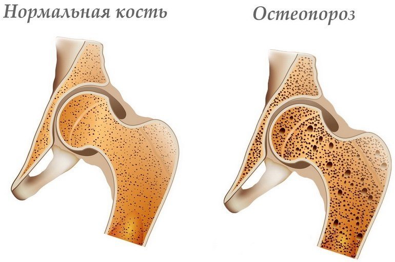 Остеопороз: причины, симптомы, лечение