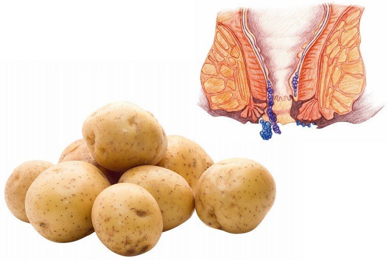 Лечение геморроя в домашних условиях быстро картофелем